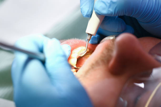 Best Emergency Root Canal Treatment in De Leon Springs, FL